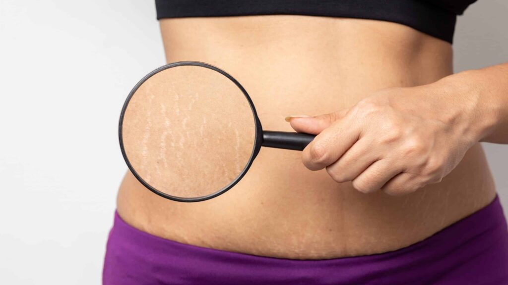 White Stretch Marks